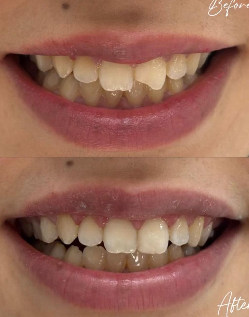 Restauration en composite &mdash; avant / apr&egrave;s