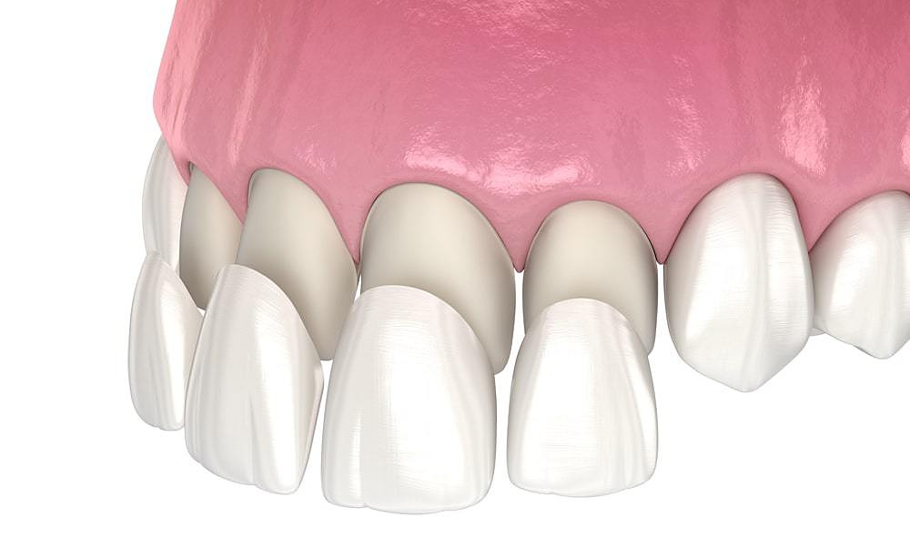 Facette dentaire en céramique posée sur les dents