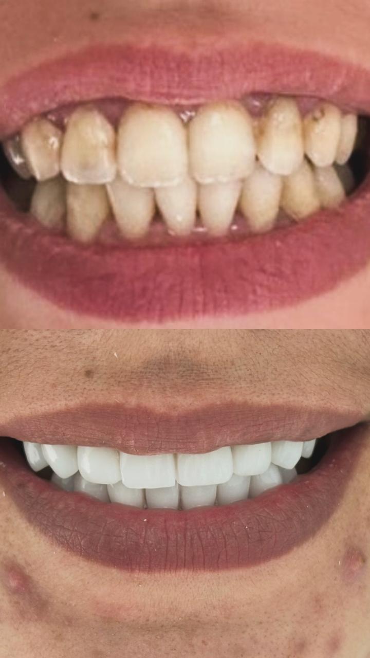 Hollywood smile &mdash; avant / apr&egrave;s