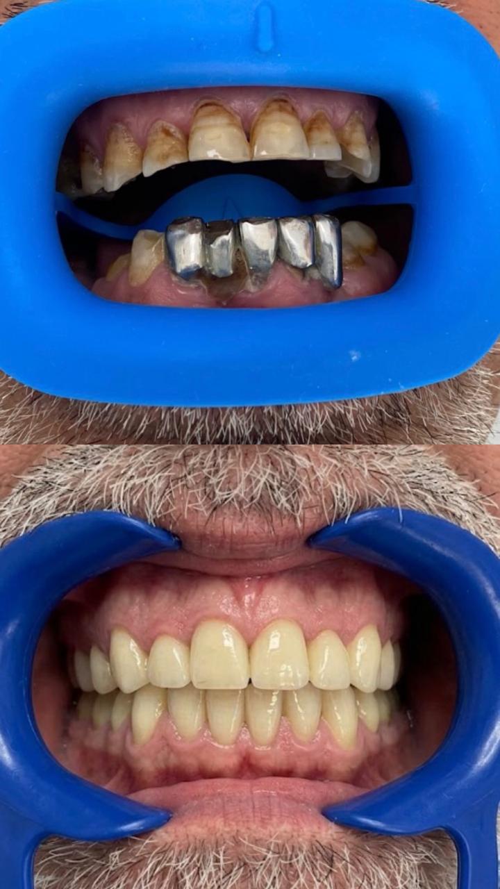 Hollywood smile &mdash; avant / apr&egrave;s