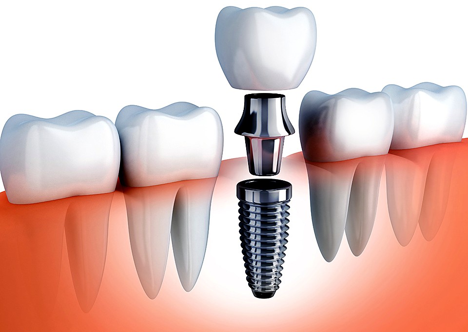 Composants d'un implant dentaire avec couronne
