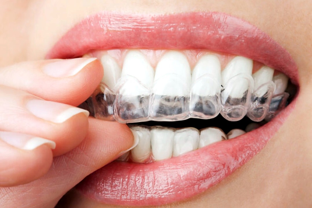 Gouttière Invisalign posée sur les dents
